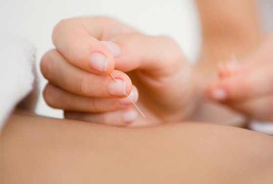 Punción seca en Salud Dinan Lugo